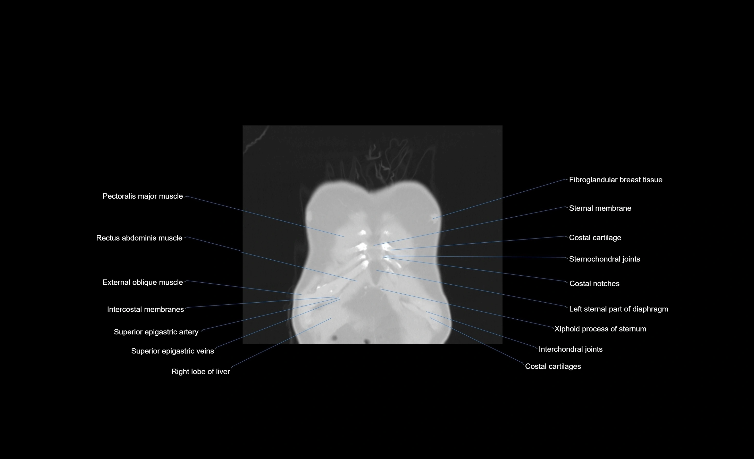 CT chest (thorax) lung window window labelled coronal cross sectional anatomy radiology image-00106.webp